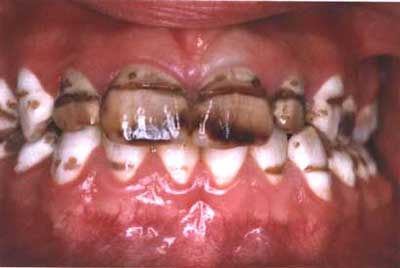 Fluorosis Dentaria.